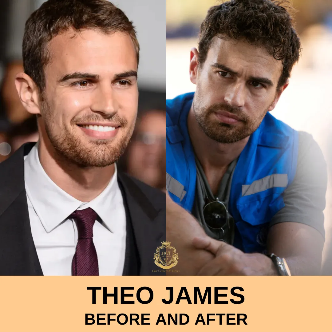 Theo James Hair Transplant