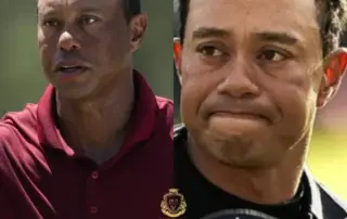 Tiger Woods Hair Transplant