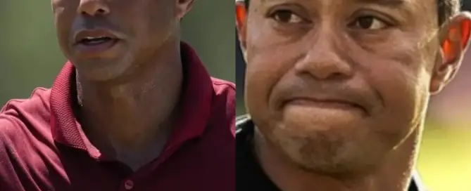 Tiger Woods Hair Transplant