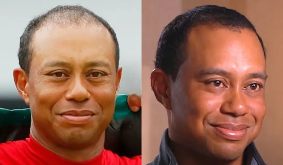 Tiger Woods Hair Transplant