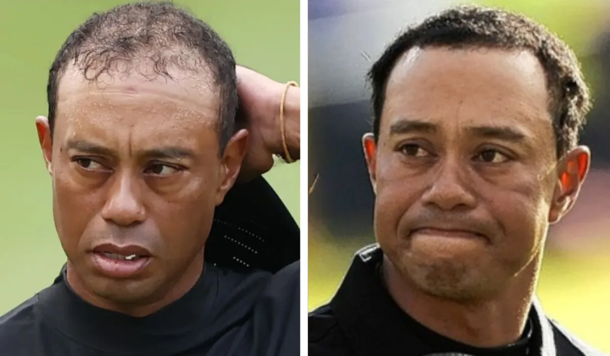 Tiger Woods Hair Transplant