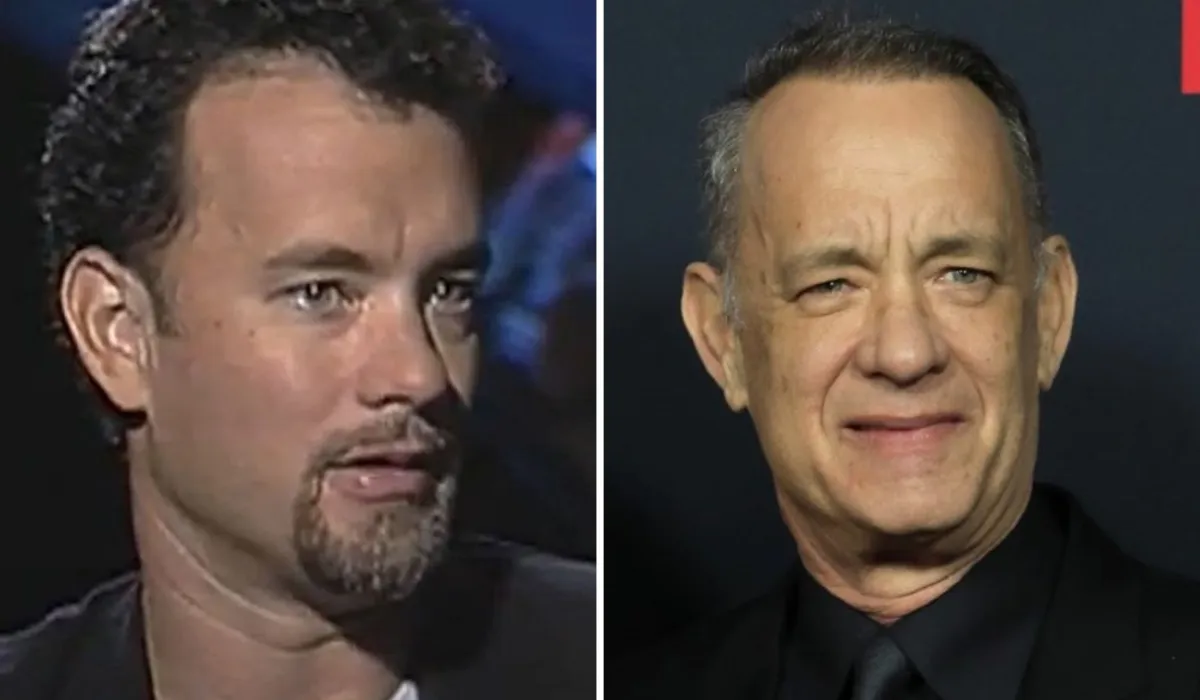 Tom Hanks Hair Transplant