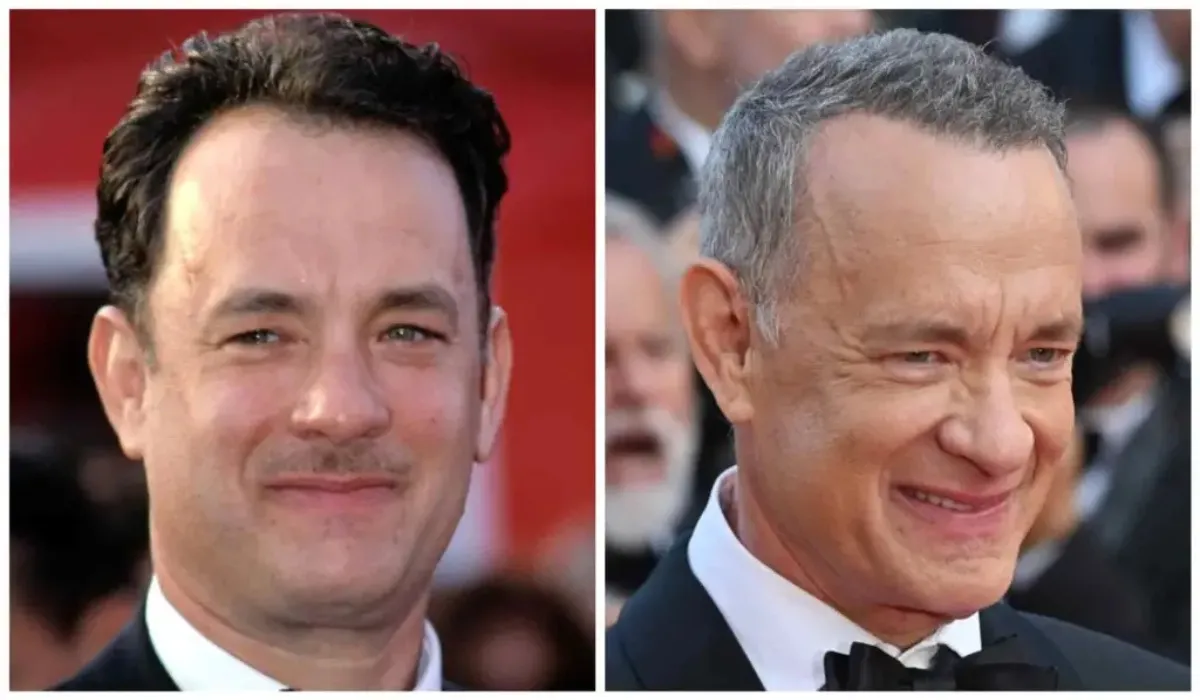 Tom Hanks Hair Transplant