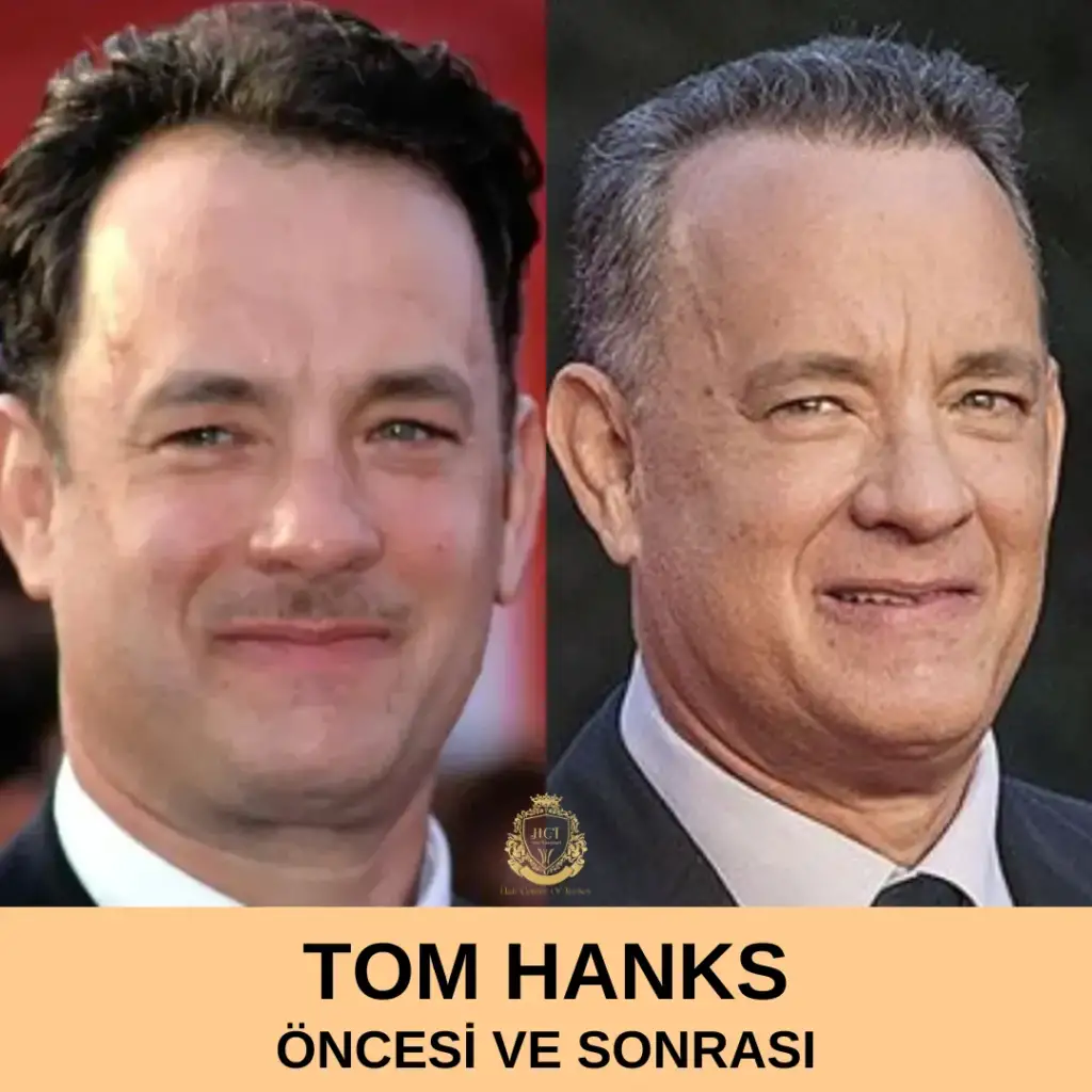 Tom Hanks Saç Ekimi