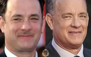 Tom Hanks Hair Transplant