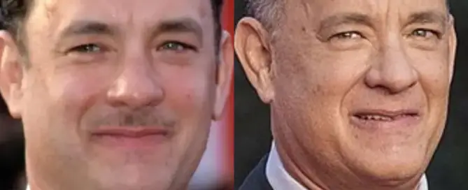 Tom Hanks Hair Transplant