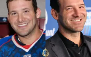 Tony Romo Hair Transplant