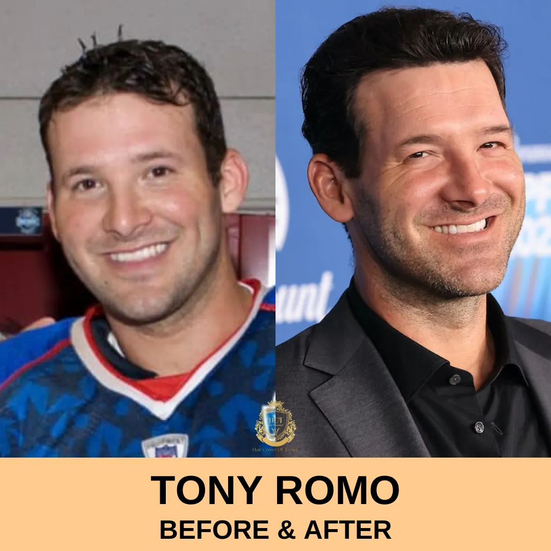 Tony Romo Hair Transplant | Hair Center of Turkey Health Center