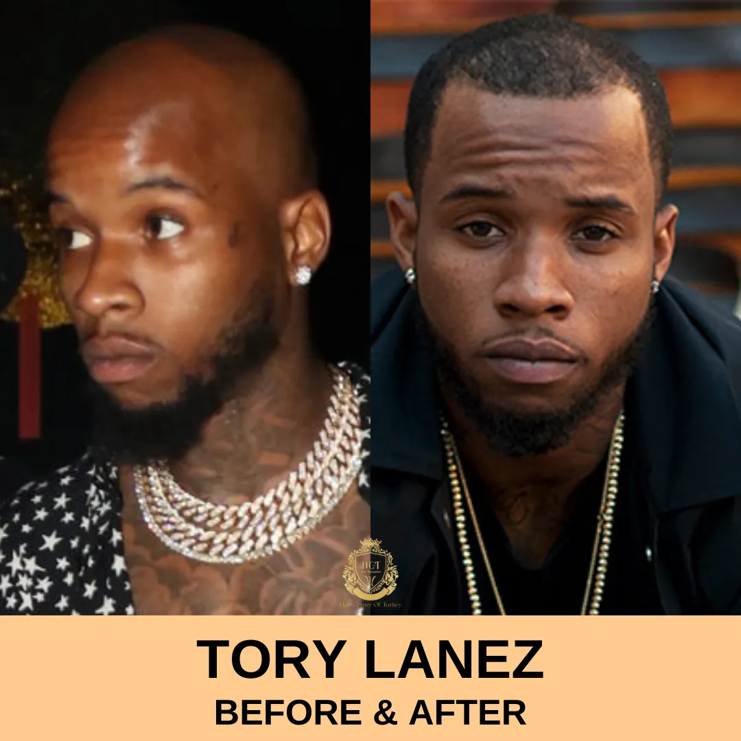 Tory Lanez Hair Transplant