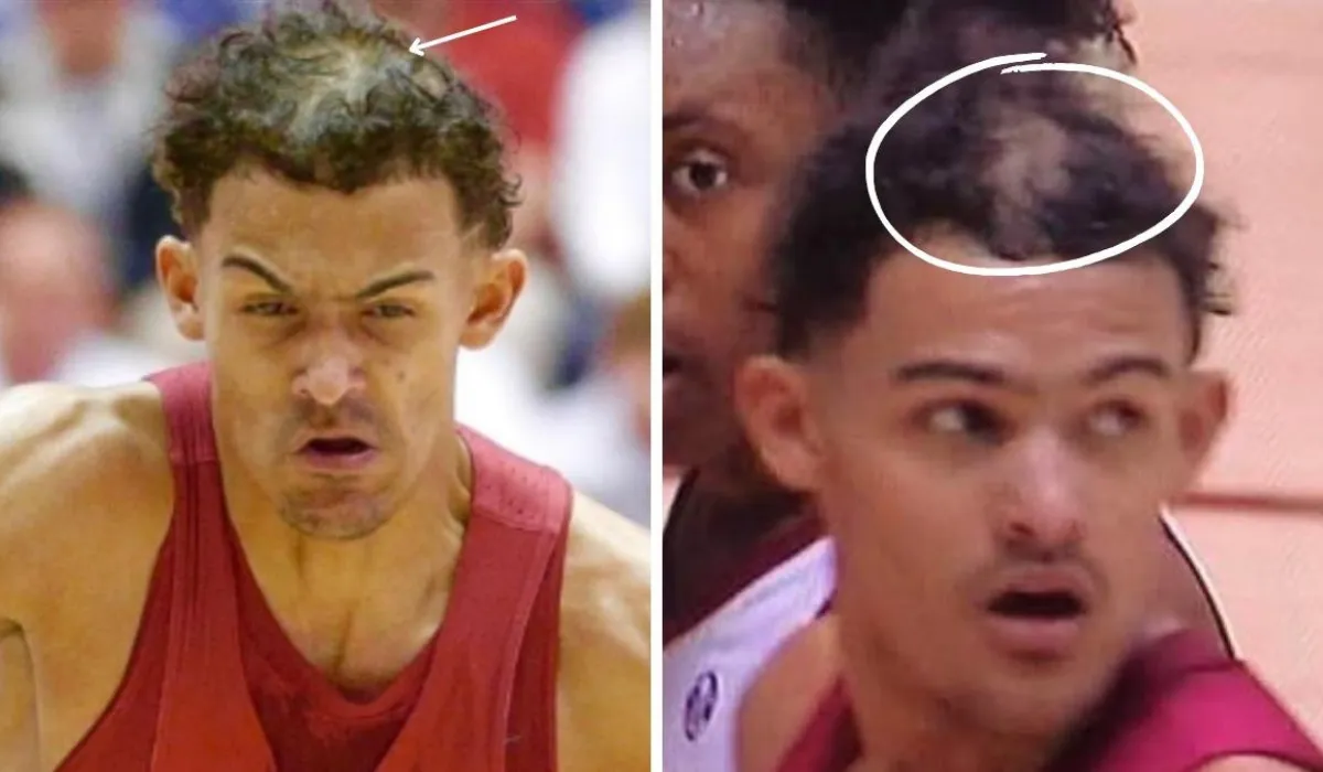 Trae Young Hair Transplant