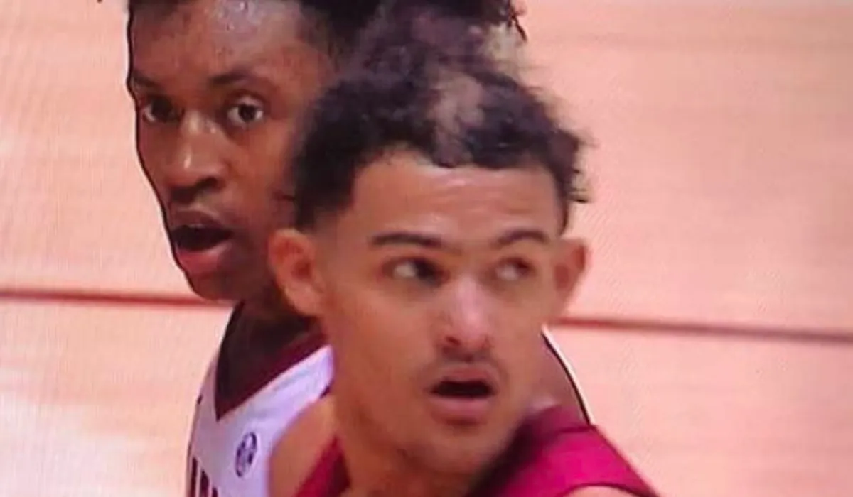 Trae Young Hair Transplant