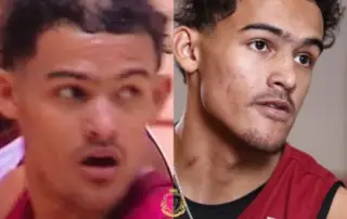 Trae Young Hair Transplant