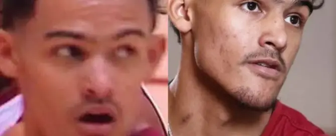 Trae Young Hair Transplant