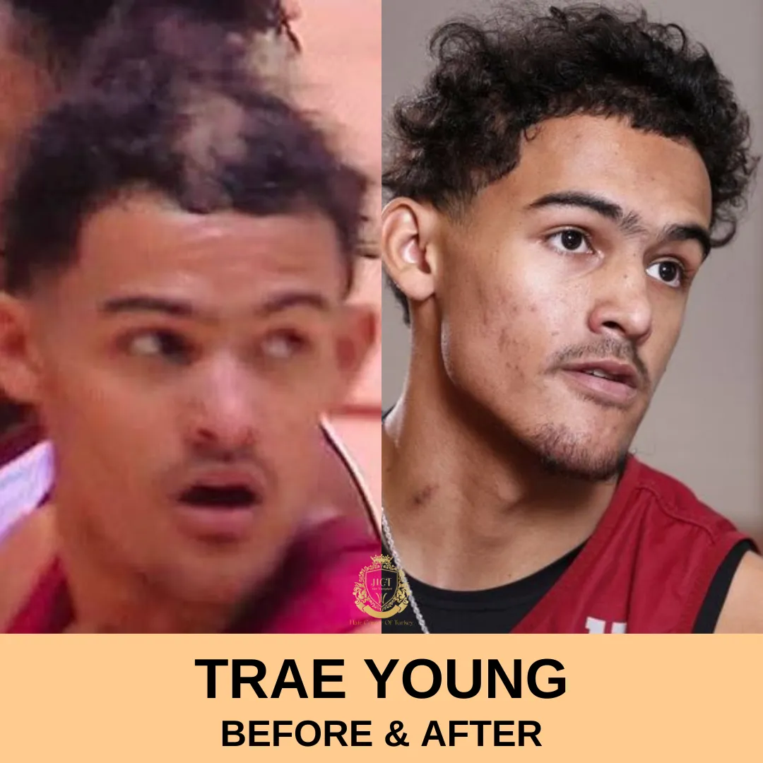 Trae Young Hair Transplant