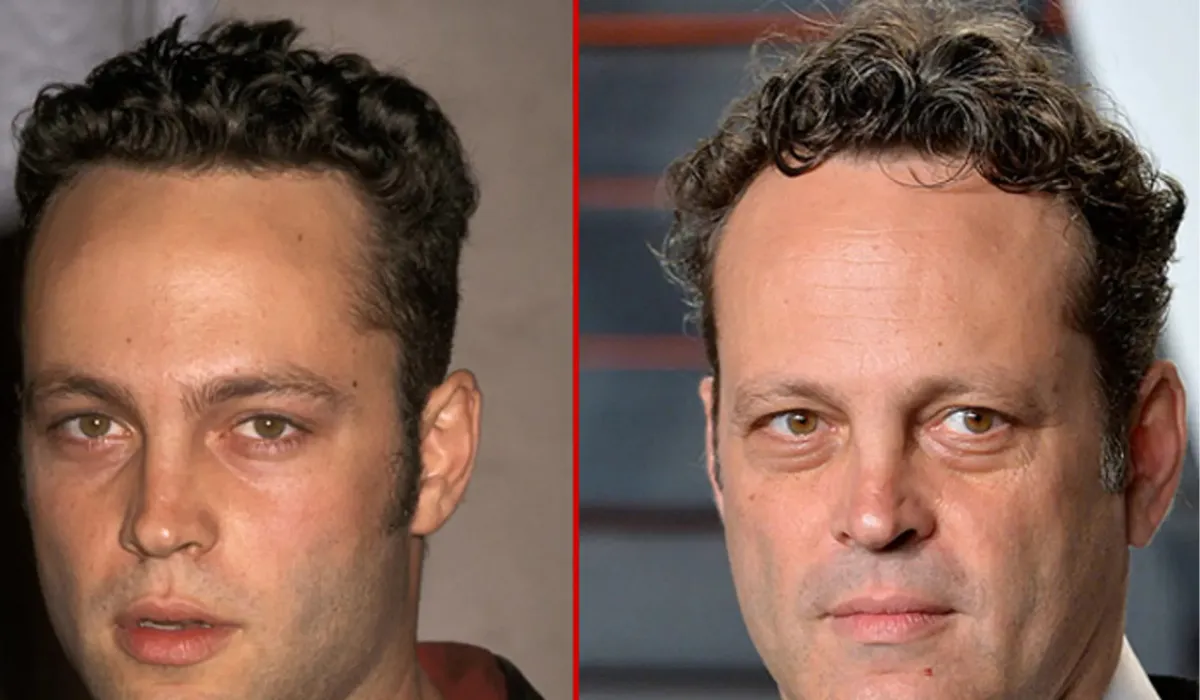 Vince Vaughn Hair Transplant