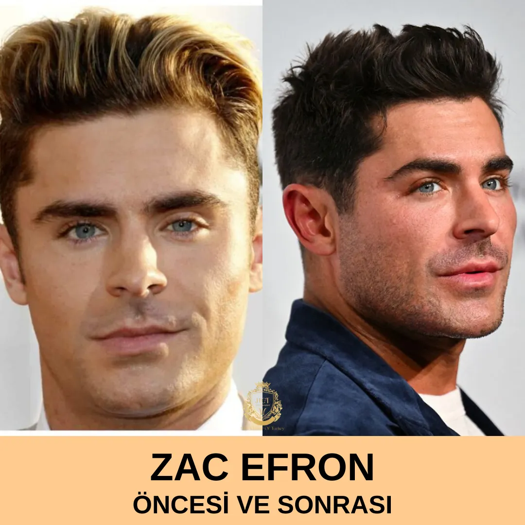 Zac Efron Saç Ekimi