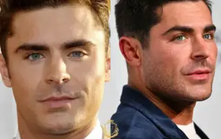 Zac Efron Hair Transplant