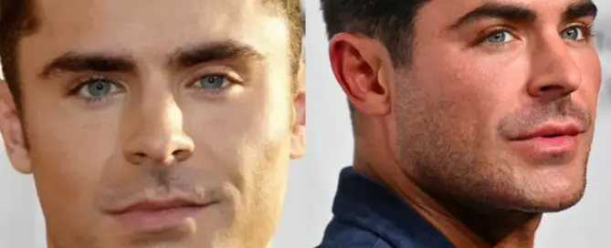 Zac Efron Hair Transplant