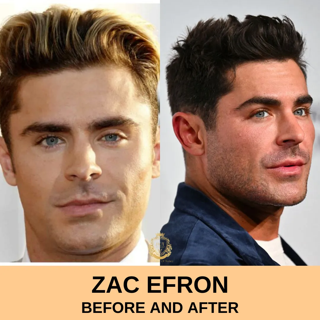 Zac Efron Hair Transplant