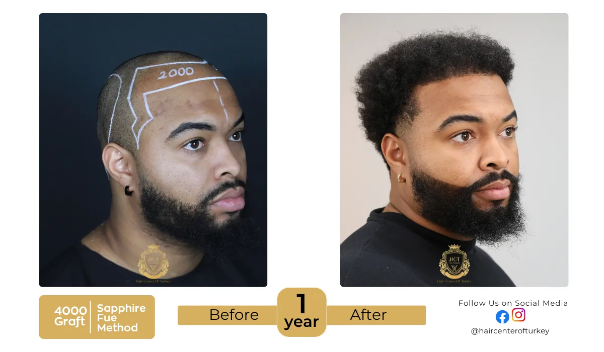 hair transplant process hair transplant before and after