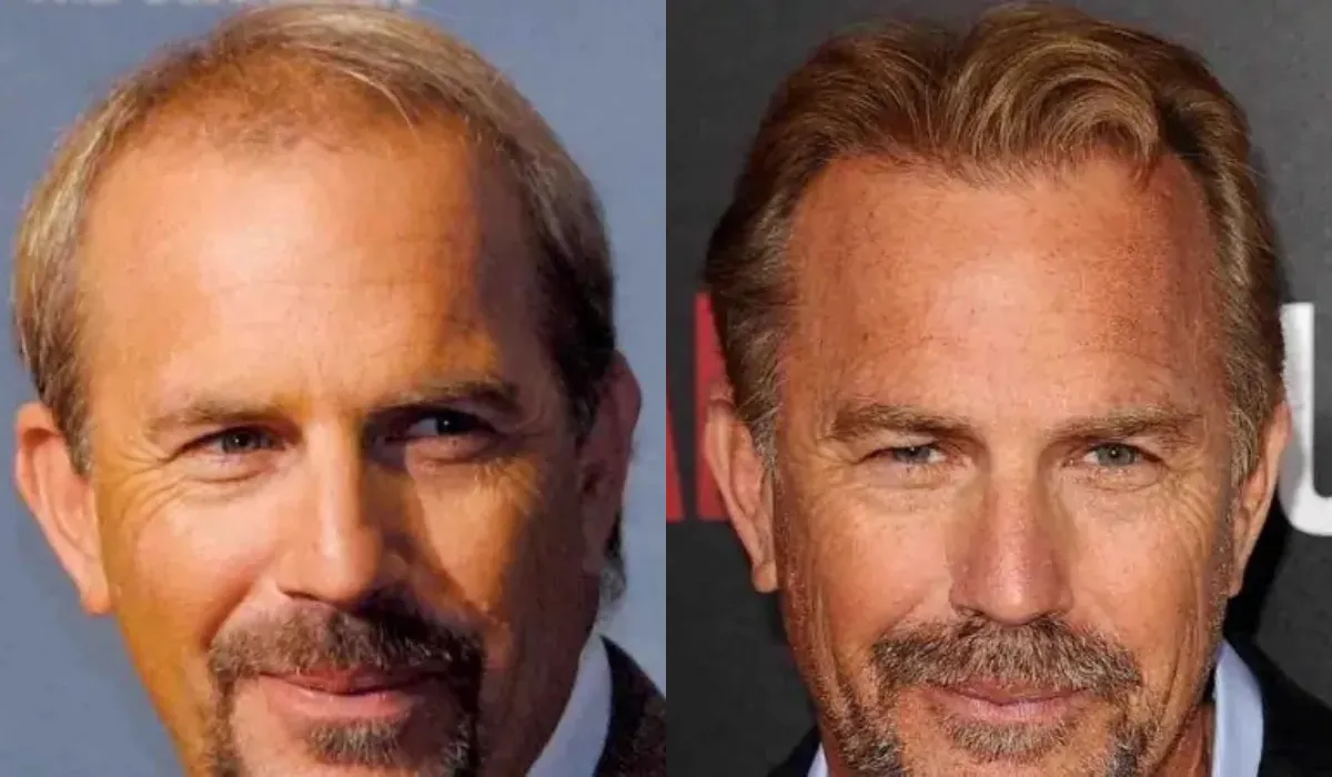 kevin costner hair transplant