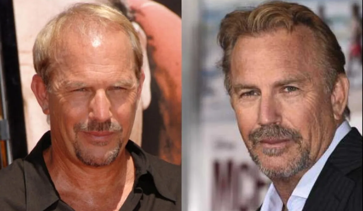 kevin costner hair transplant