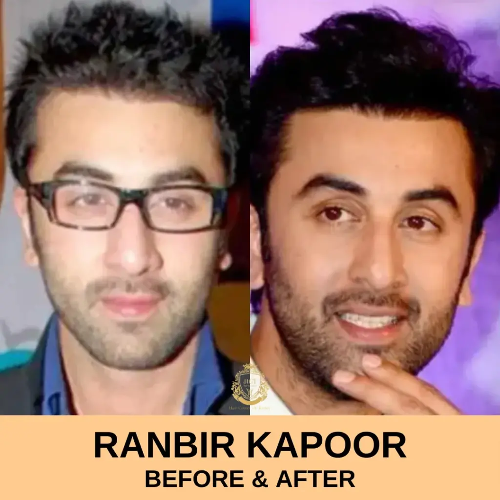 ranbir kapoor hair transplant before after