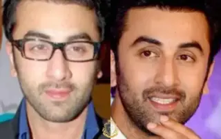 ranbir kapoor hair transplant before after