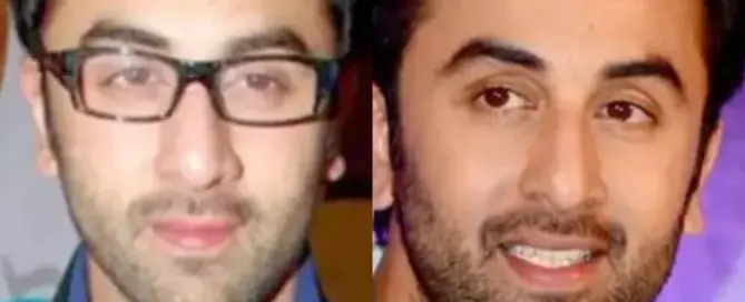 ranbir kapoor hair transplant before after