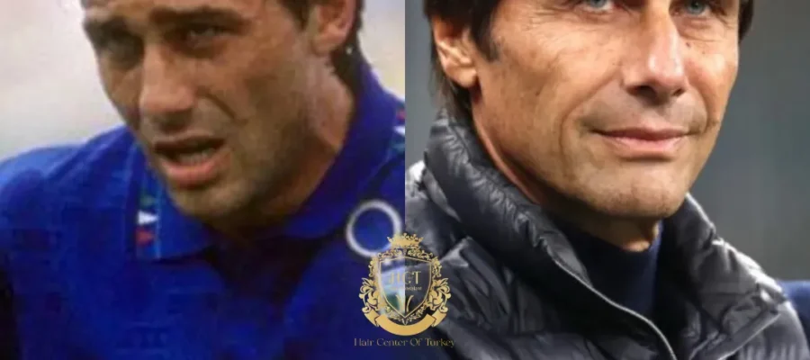 Greffe de cheveux Antonio Conte 1 Greffe de cheveux Antonio Conte