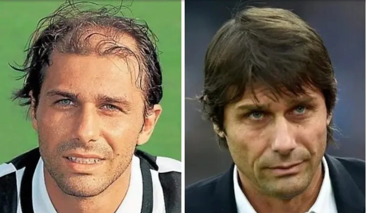 Antonio Conte Hair Transplant