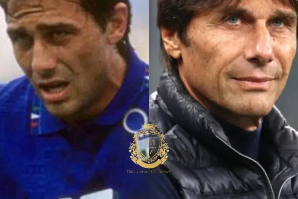 Antonio Conte Hair Transplant