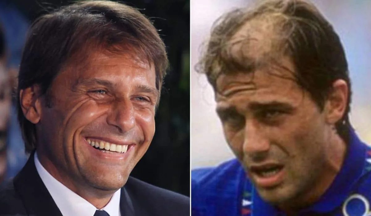 Antonio Conte Hair Transplant