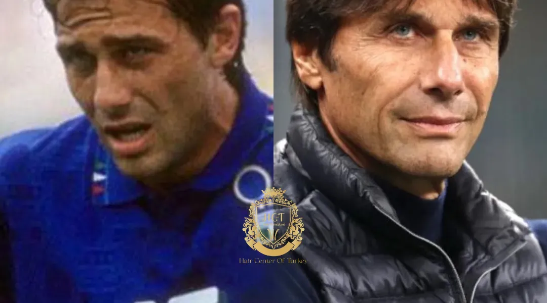 Antonio Conte Haartransplantatie