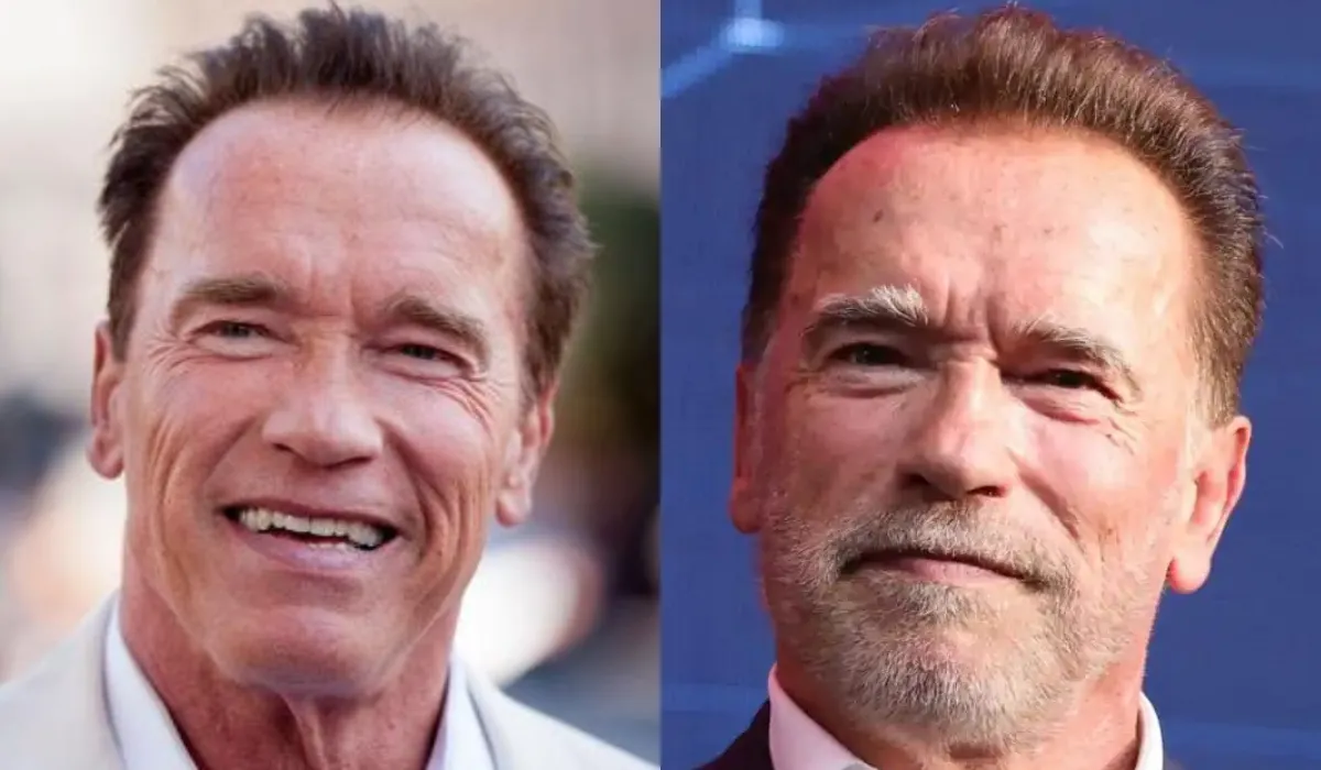 Arnold Schwarzenegger Hair Transplant