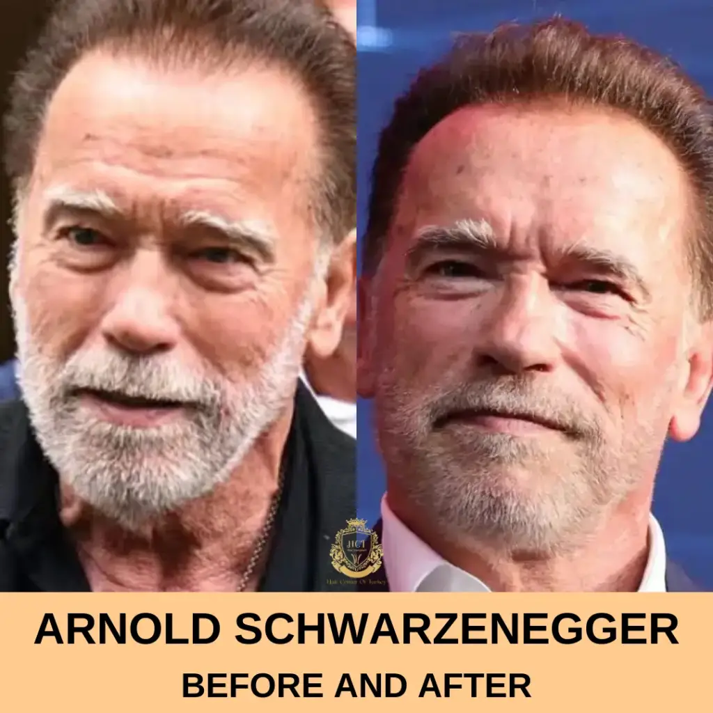 Arnold Schwarzenegger Hair Transplant