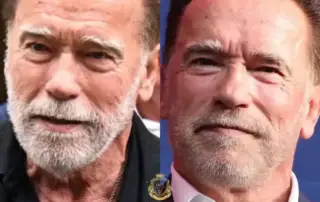 Arnold Schwarzenegger Hair Transplant