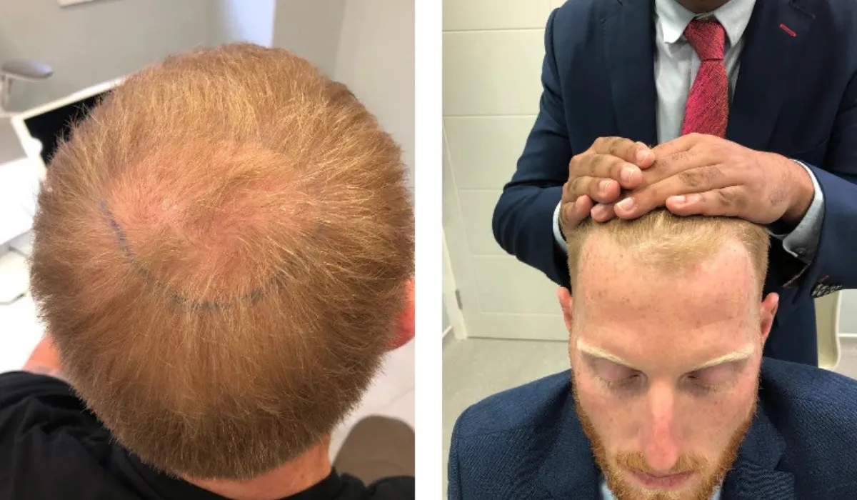 Ben Stokes Hair Transplant