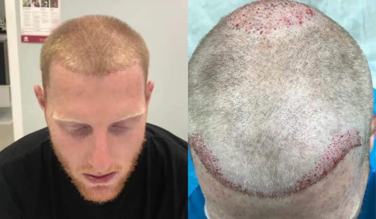 Ben Stokes Hair Transplant