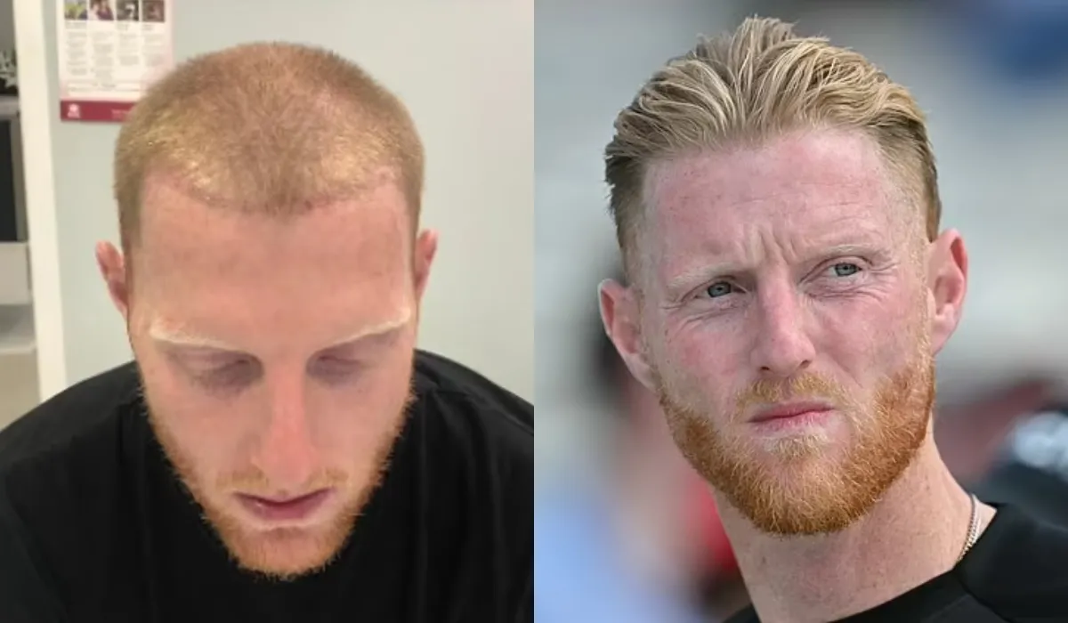 Ben Stokes Hair Transplant