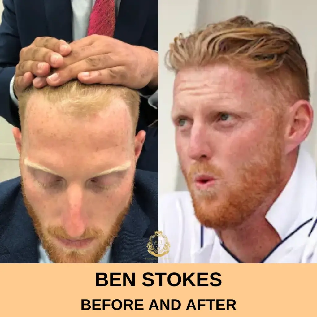 Ben Stokes Hair Transplant