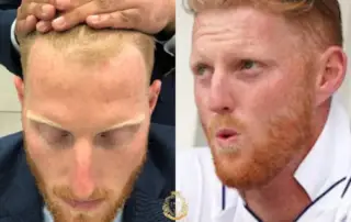 Ben Stokes Hair Transplant