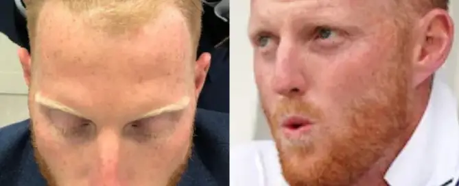 Ben Stokes Hair Transplant