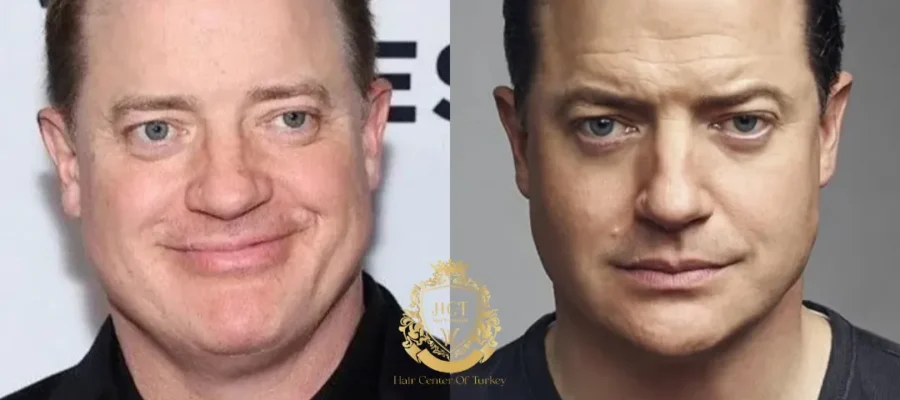 Transplante capilar de Brendan Fraser