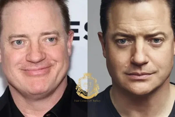 Brendan Fraser Saç Ekimi