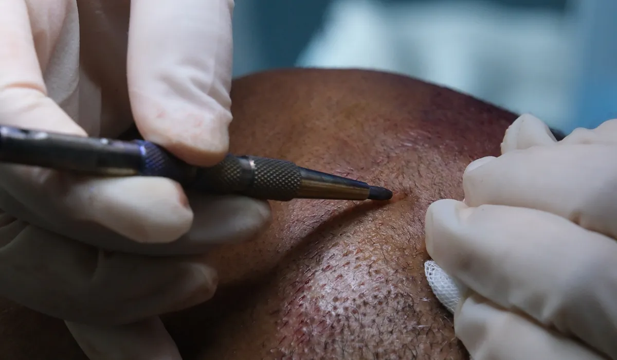 Brendan Fraser Hair Transplant