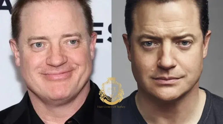 Brendan Fraser Haartransplantatie