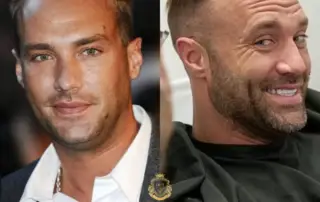 Calum Best Hair Transplant