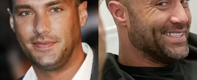 Calum Best Hair Transplant