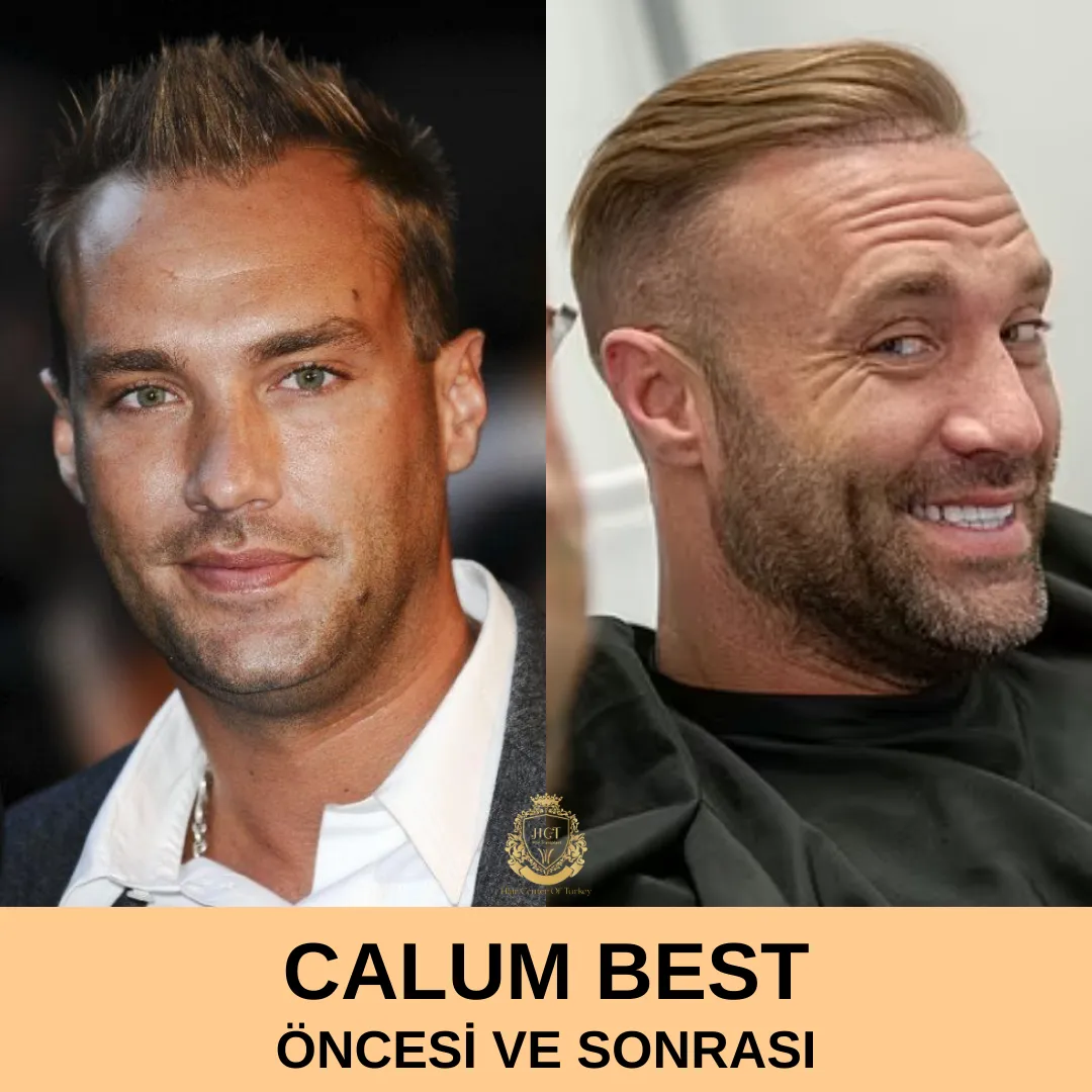 Calum Best Hair Transplant